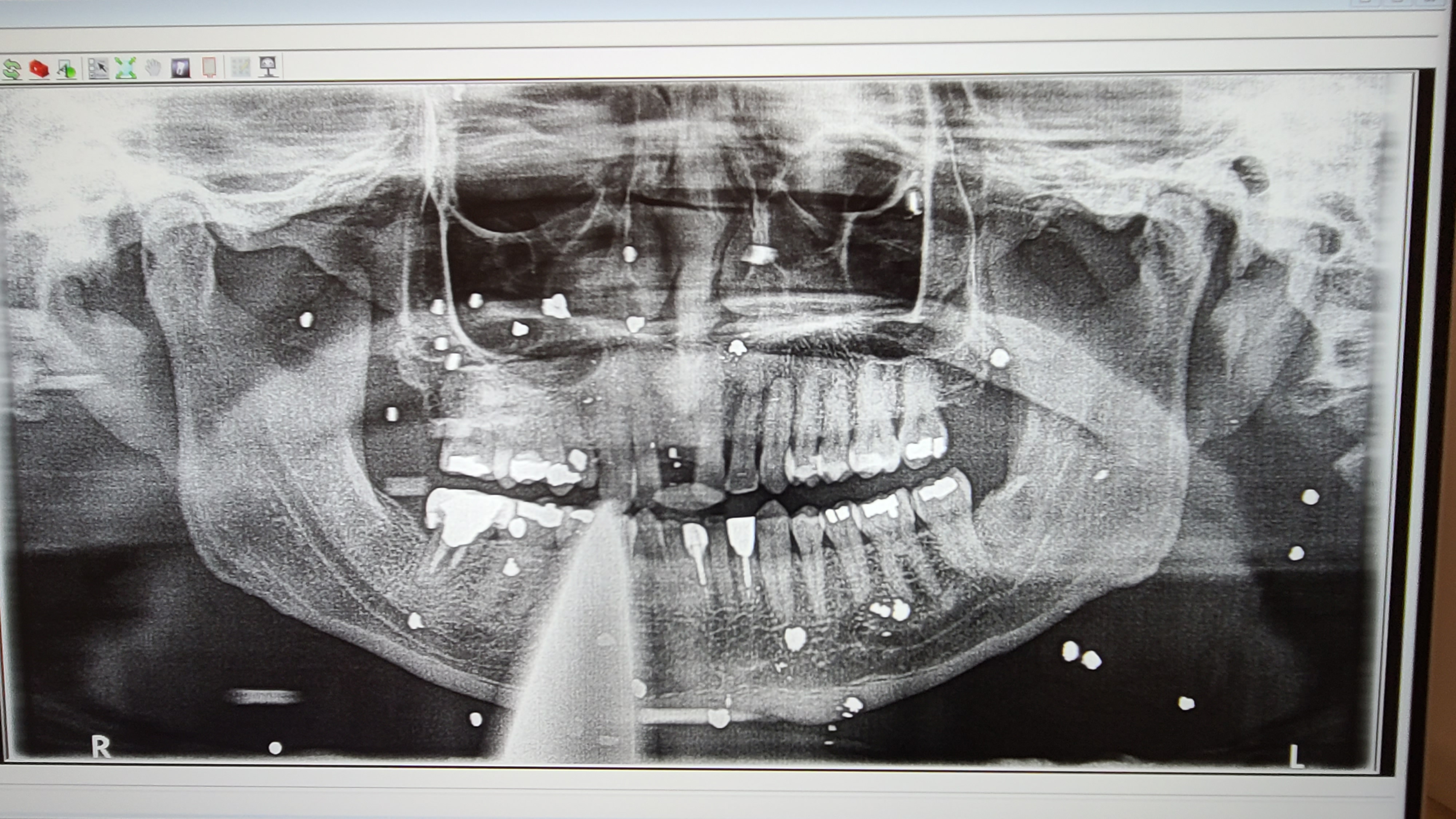 X-ray showing shotgun fragments still embedded decades later